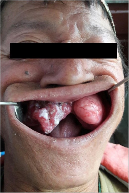 Patient’s father presenting with swelling of his gum with areas of surface ulceration and pus collection.