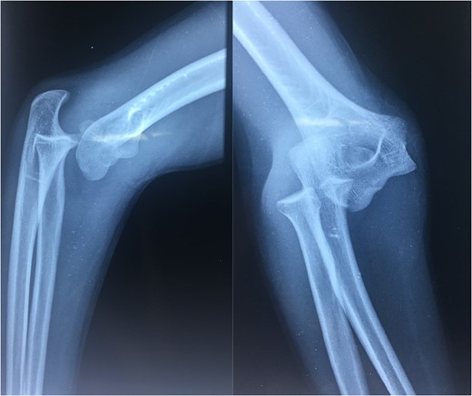 X-rays showing an initial view of the patients left elbow.