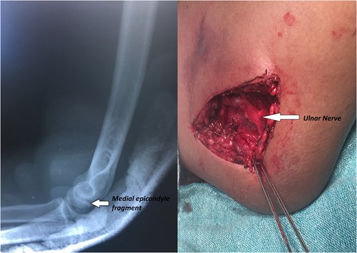 X-rays showing the result of the first attempt of closed manipulation and open reduction.