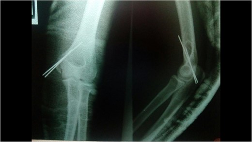 Post-operative radiographs.