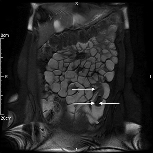 MR image of the lipoma (single arrow, left side) and the intussusception (double arrow, right side).