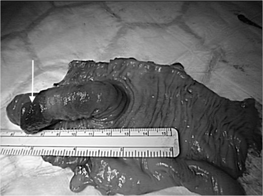 Resected specimen demonstrating the lipomata (single arrow) of the jejunum and intussusception with its length.