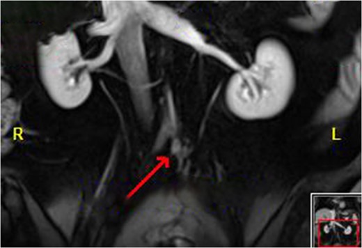 Disease of the inferior mesenteric artery stump. The arrow indicates the bulky disease.