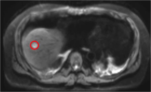 Liver Metastasis. The red circle indicates the 2-cm site of metastasis.