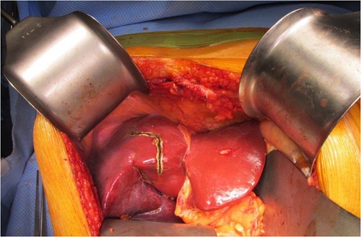 Scoring of planned liver resection.