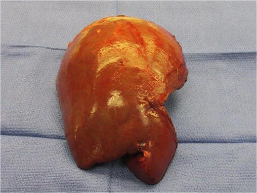 Liver resection specimen.