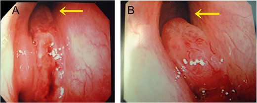 Endoscopic view of the right nasal cavity. (A) Before and (B) after rIL-2 administration. After rIL-2 administration, the tumor size was reduced (arrow).