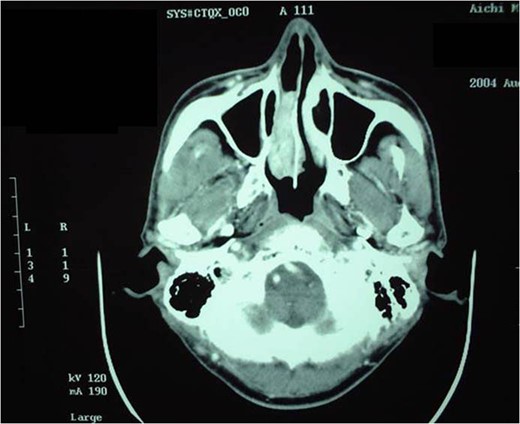 Enhanced CT before rIL-2 administration. A heterogeneous mass lesion with an enhancement effect filled the right nasal cavity.