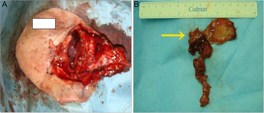 (A) After wide surgical excision (B) gross specimen. The tumor with a pedicle on the right nasal septum near the olfactory cleft was extirpated totally, leaving an adequate free margin. (arrow: pedicle of tumor).