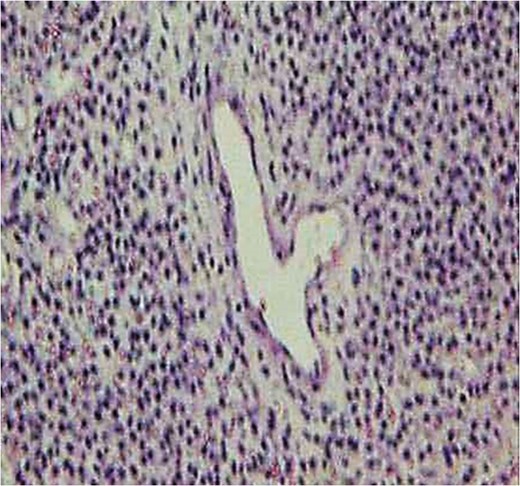 Pathological section (H-E staining). A proliferation of spindle-shaped pericytes surrounding the ectatic blood vessels to form a so-called ‘staghorn structure’ was shown.