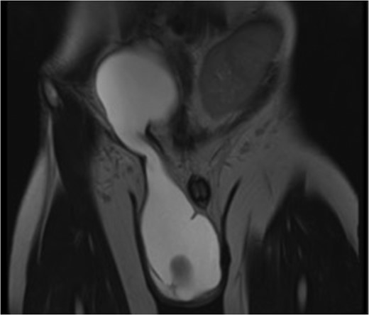 T2 weighted MRI pelvis (coronal section). MRI pelvis demonstrates a massive communicating ASH/SIR. A characteristic ‘hourglass’ shape is shown, along with the left sided transplant kidney