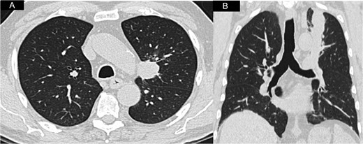 A and B Axial and coronal CT-scan view showing the left peri-hilar lung mass in close proximity to the main pulmonary artery.