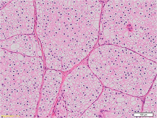 Histological section of the specimen, magnification 10×, hematoxylin-eosin staining: the tumour cells have well defined cell membranes and abundant cytoplasm that is pale eosinophilic to clear.