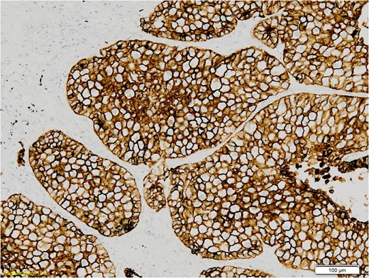 Himmunohistochemistry section of the specimen, magnification 10×: The tumour cells show strong membrane staining with CK7.