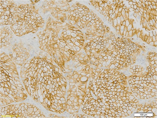 Himmunohistochemistry section of the specimen, magnification 10×: The tumour cells show strong membrane staining with CD117.