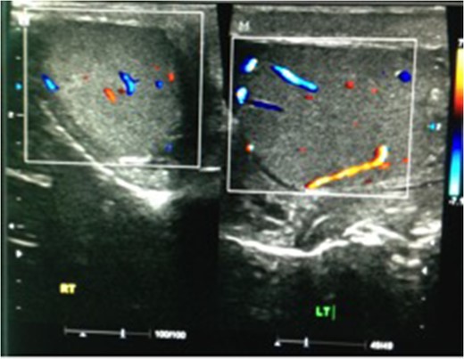 Ultrasound scan showing both testicles at initial presentation, with increased flow on the left side, indicative of EO.