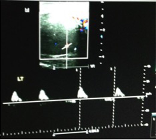Repeat ultrasound scan 6 h later showing reversal of diastolic flow.