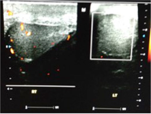 Repeat ultrasound scan showing no flow within the left testicle.
