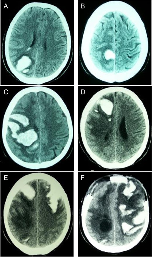 Sequential CT head scans. (A) 3.5 cm ICH in right parieto-occipital lobe with peripheral rim of edema and intraventricular extension; (B) 2.5 cm ICH anterior to first bleed with small ring of surrounding edema; (C) 7 × 4 cm right fronto-parietal ICH with intraventricular extension and subfalcine herniation; (D) 2 × 4 cm ICH in right frontal lobe with surrounding halo of edema and 8 mm subfalcine herniation; (E) 5 × 3 cm left anterior frontal lobe ICH with mild surrounding edema; (F) left fronto-parietal ICH with 2 cm midline-shift.