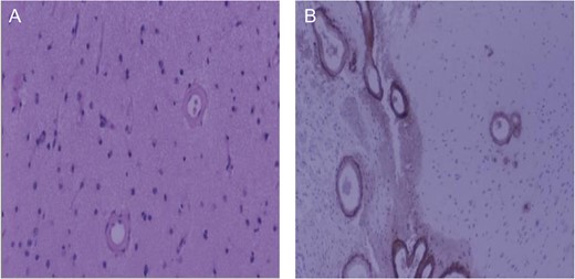Brain biopsy of patient. (A) Low magnification, hematoxylin and eosin stain of cerebral cortex. Typical smooth vessel wall thickening associated with amyloid angiopathy; (B) Low magnification, beta-amyloid immunohistochemistry. Intense beta-amyloid deposition in leptomeningeal (left) and cortical (right) vessels.