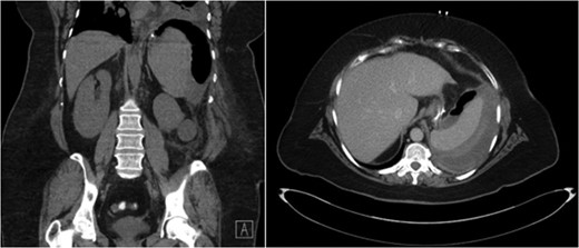 CT abdomen demonstrating air and fluid contained with the splenic capsule.