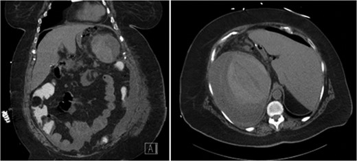 CT abdomen demonstrating extravasation of contrast and free intra-peritoneal air, with the absence of subcapsular air.