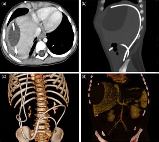 The enhanced CT before operation. (a) Axial CT showed water-like hypointense mass and catheter image in the liver contour. (b) Sagittal CT revealed catheter image under liver capsule and the homogeneous and well-defined mass in the liver contour. (c) Three-dimensional image of catheter in abdominal cavity. (d) The mass in the liver contour.