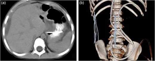 The CT scan after operation. (a) Axial CT revealed a small part of effusion remained in the liver contour. (b) Three-dimensional image of catheter showed the distal catheter in the left abdominal cavity.