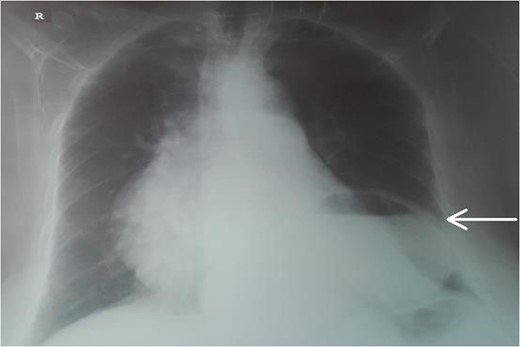 Chest radiogram. The arrow shows the dilated intrathoracic stomach.
