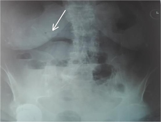 Abdominal radiogram. The arrow shows the air in the bile ducts.
