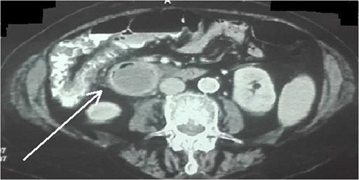 Abdominal CT scan (axial plane). The arrow shows the impacted gallstone.