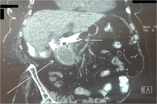 Abdominal CT scan (coronal plane). The long arrow shows the impacted gallstone and the short arrow shows the free air and the leakage of oral contrast agent.