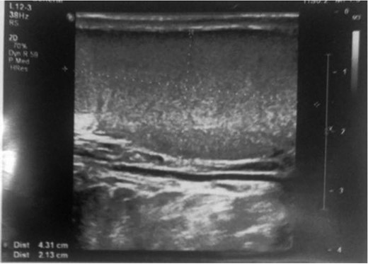 Ultrasound picture of the testis showed normal echogenicity without any abnormality.