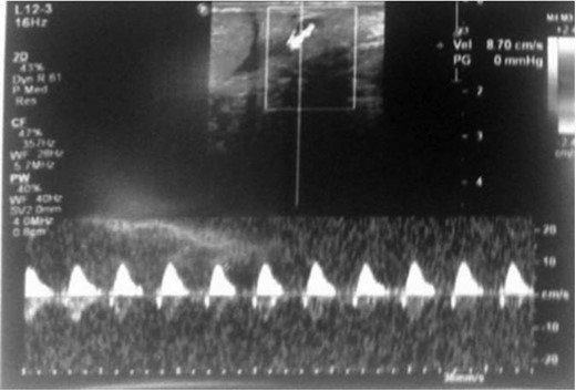 Doppler ultrasound using gray scale method of the testis showed normal flow pattern of testicular artery.
