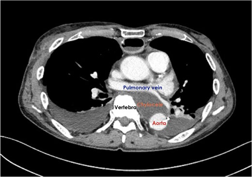 Computed tomography scan demonstrated the presence of a retrocardiac fluid collection when the cardiac tamponade relapsed.