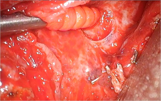 A pericardial hole was confirmed to be close to the leakage point.