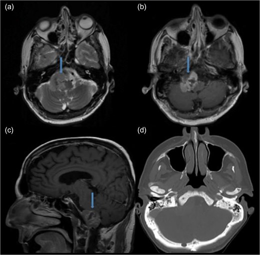 Preoperative MRI demonstrating an anterolateral right foramen magnum mass. (a) Axial T2-weighted MRI. (b) Axial T1-weighted contrast enhanced MRI. (c) Sagittal T1-weighted contrast enhanced MRI. (d) Axial CT image of brain shows no bone sclerosis or destruction.