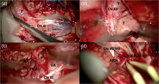 Intraoperative images showing (a) the T that was extrinsic to the cerebellum and medulla oblongata (MO), was pushing CN XI medially and encasing dentate ligament (DL). (b) CN XII encased by T. (c) PICA and Vertebral Artery (VA) encased by T. (d) After tumor resecting cranial nerve VII, VIII (CN VII, VIII), anterior inferior cerebellar artery (AICA) and CN IX, X, XI preserved.