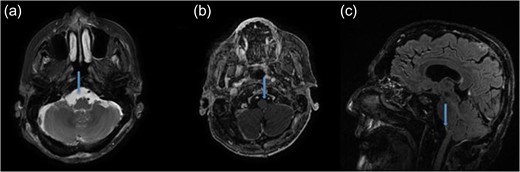 Postoperative MRI demonstrating the gross total mass resection. (a) Axial T2-weighted MRI. (b) Axial T1-weighted contrast enhanced MRI. (c) Sagittal T1-weighted contrast enhanced MRI.