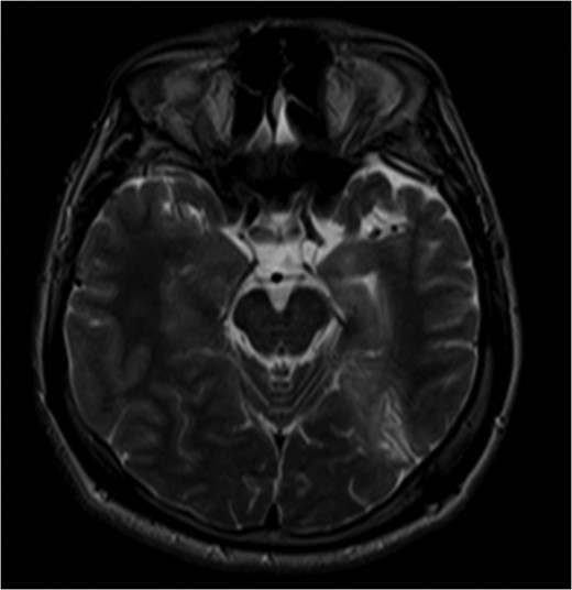 Pre-op MRI images. T2 weighted images demonstrate atrophy and hyperintense signal along the left medial temporal lobe.