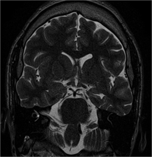 Pre-op MRI images. T2 weighted images demonstrate atrophy and hyperintense signal along the left medial temporal lobe.