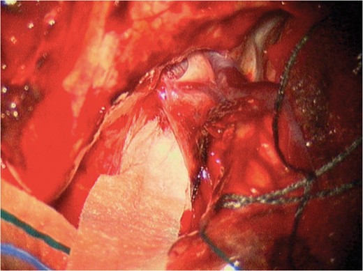 Intraoperative image during part 2 (resection) demonstrating the two large temporopolar bridging veins where resistance was met while attempting AMTS passage.