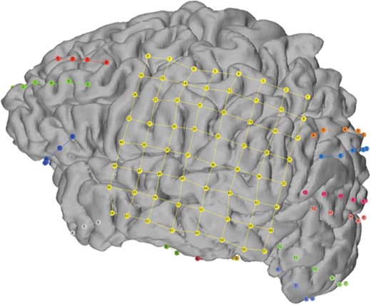 Intracranial EEG study.