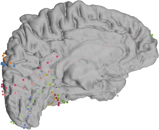 Intracranial EEG study.