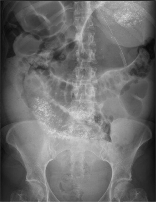 Plain abdominal X-Ray post gastrograffin study.
