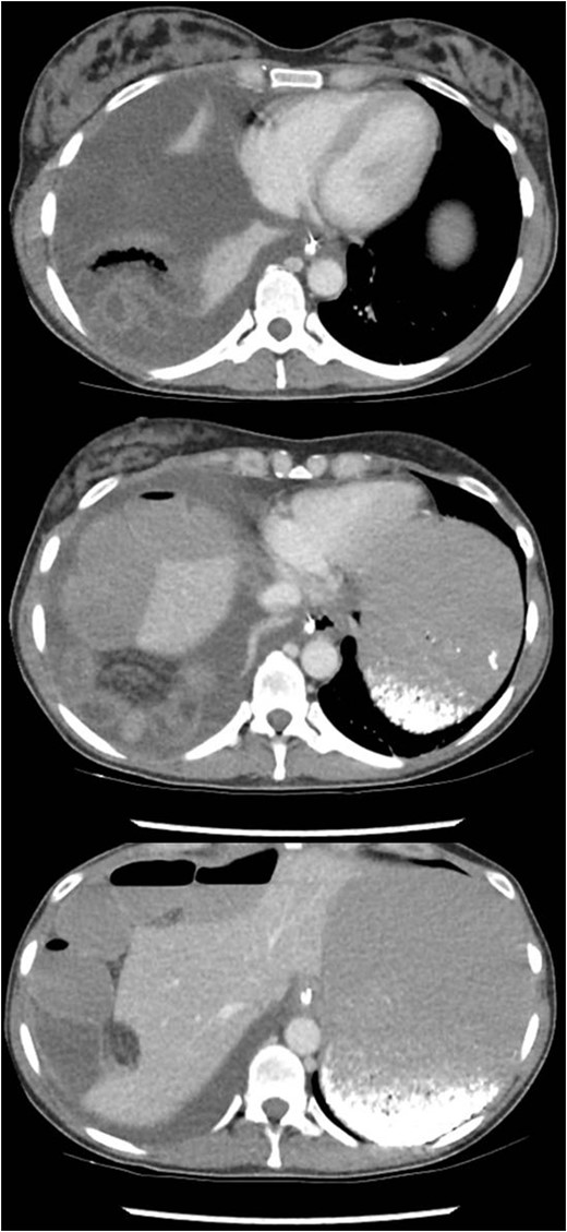 Axial views of the patient’s CT abdomen.