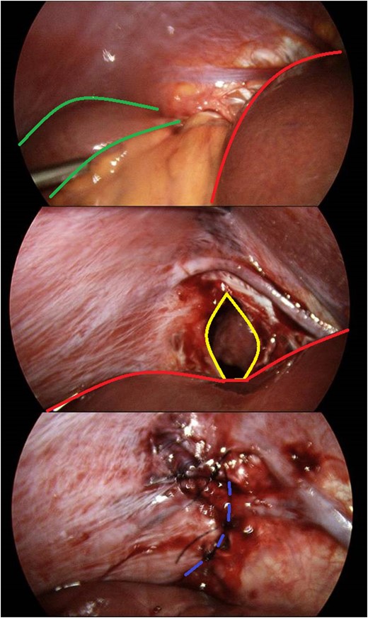 Identification and laparoscopic reduction of diaphragmatic hernia in sequence. Green borders outline small bowel; red borders delineates hepatic edge; yellow margins signifies diaphragmatic defect; and purple hashed line is closed defect.