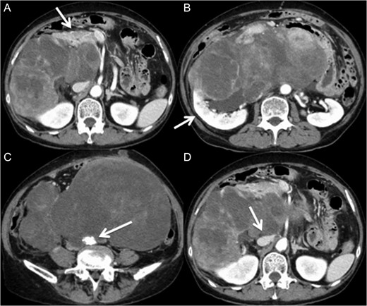Multidetector CT scan (axial view). The large retroperitoneal tumor was adjacent to the duodenum, the head of the pancreas (A) and the right kidney (B). The tumor surrounded the abdominal aorta (C) and the inferior vena cava (D).