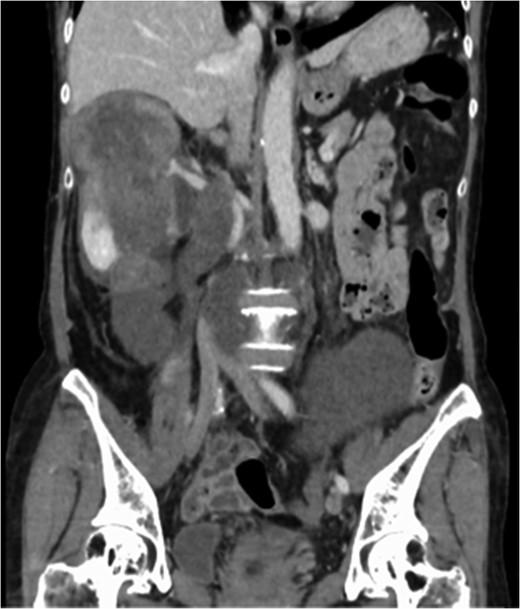 Multidetector CT scan (coronal view). The tumor invaded the IVC from the orifice of the right renal vein and the peripheral IVC was almost fully occluded.