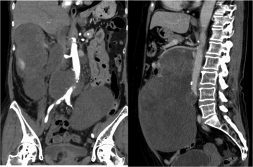 Multidetector CT scan (coronal view and sagittal view). The tumor surrounded the abdominal aorta from the superior mesenteric artery orifice to the common iliac artery bifurcation.